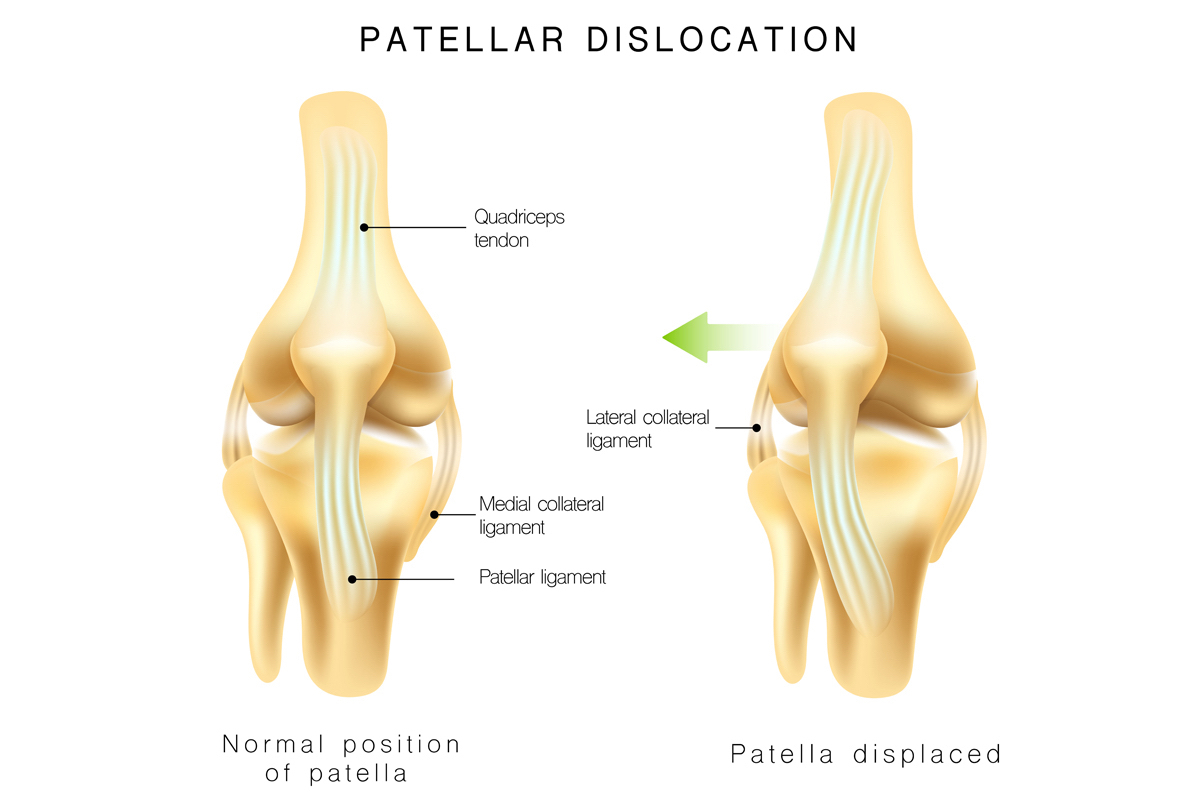 Patellofemoral dislocation discount